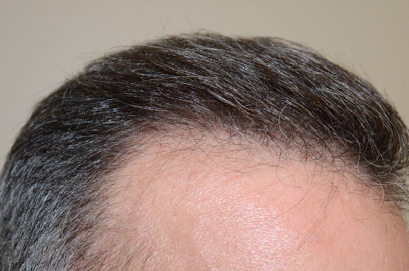 Hair Restoration for Men Before & After Gallery - Patient 307601 - Image 10