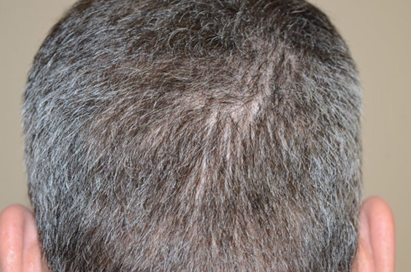 Hair Restoration for Men Before & After Gallery - Patient 105497 - Image 10