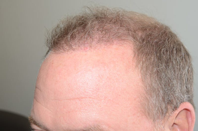 Hair Restoration for Men Before & After Gallery - Patient 292707 - Image 6
