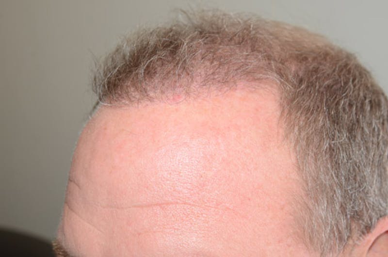 Hair Restoration for Men Before & After Gallery - Patient 257665 - Image 6