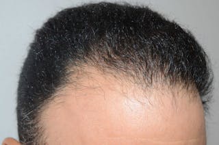 Hair Restoration for Men Before & After Gallery - Patient 353810 - Image 4
