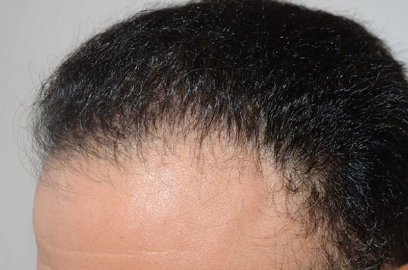 Hair Restoration for Men Before & After Gallery - Patient 203144 - Image 4