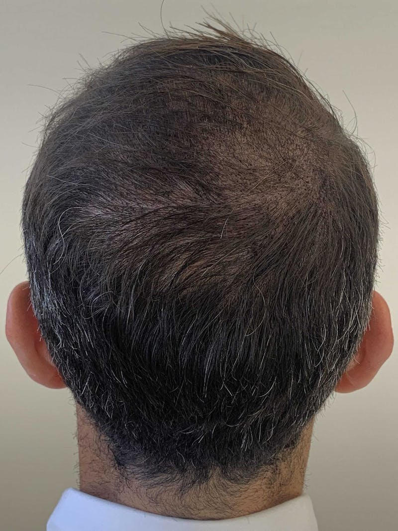 Scalp Micropigmentation Procedures Before & After Gallery - Patient 338710 - Image 2