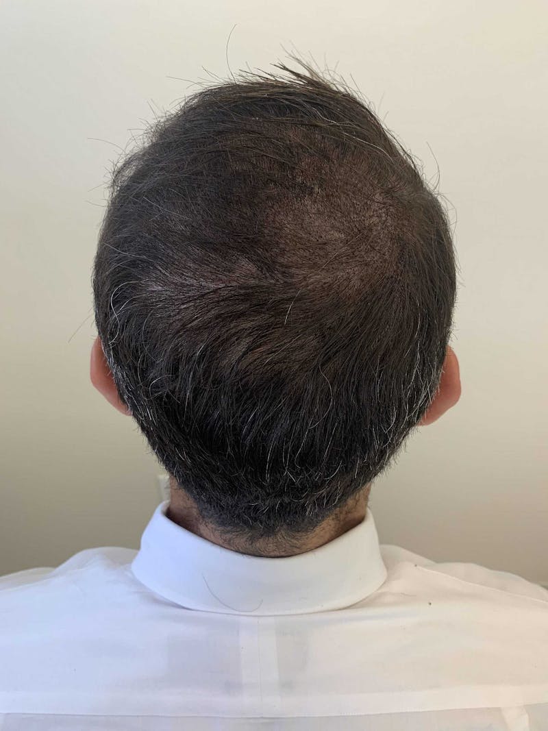 Scalp Micropigmentation Procedures Before & After Gallery - Patient 657954 - Image 2