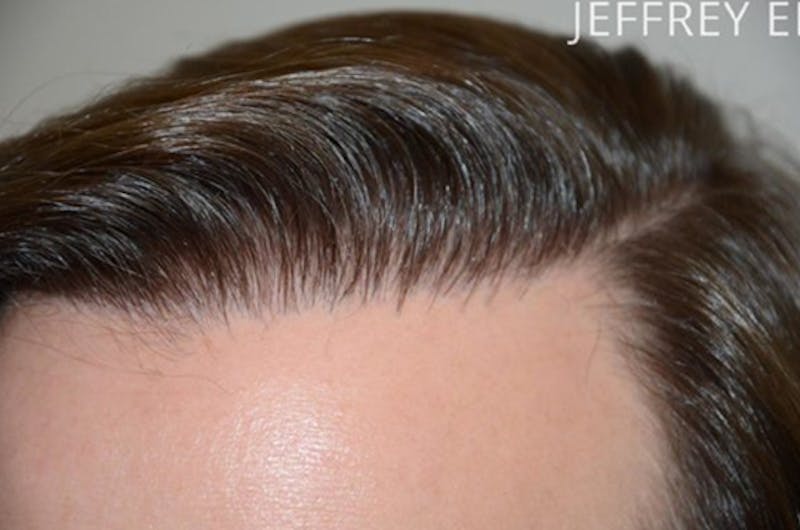 Hair Transplant Repair Before & After Gallery - Patient 127014 - Image 3