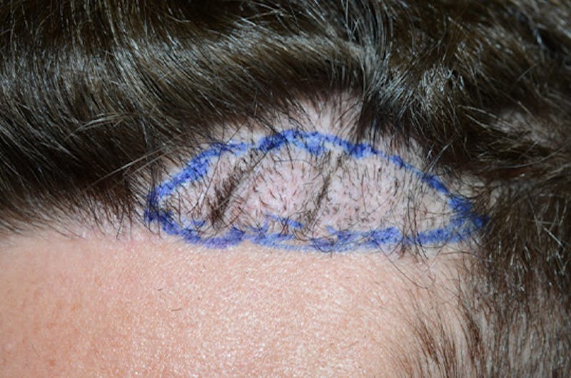 Hair Transplant Repair Before & After Gallery - Patient 669267 - Image 1