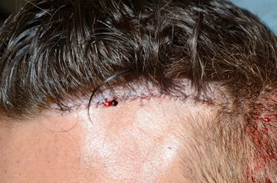 Hair Transplant Repair Before & After Gallery - Patient 545808 - Image 2