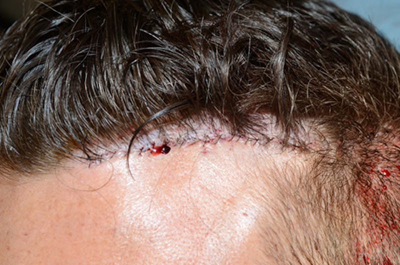 Hair Transplant Repair Before & After Gallery - Patient 151836 - Image 1