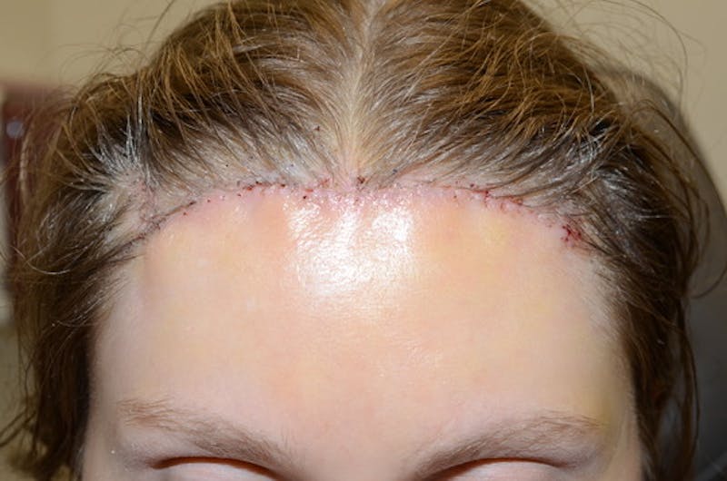 Hair Transplant Repair Before & After Gallery - Patient 538469 - Image 2