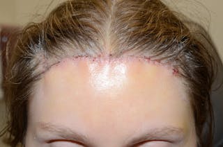 Hair Transplant Repair Before & After Gallery - Patient 294812 - Image 2