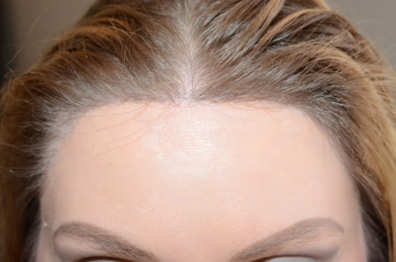 Hairline Lowering Surgery Before & After Gallery - Patient 306857 - Image 2