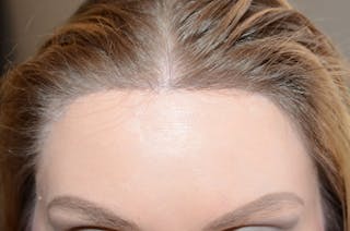 Hairline Lowering Surgery Before & After Gallery - Patient 306857 - Image 2