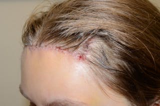 Hair Transplant Repair Before & After Gallery - Patient 113684 - Image 4