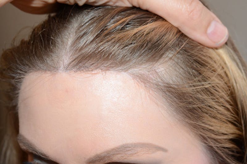 Hairline Lowering Surgery Before & After Gallery - Patient 306857 - Image 4