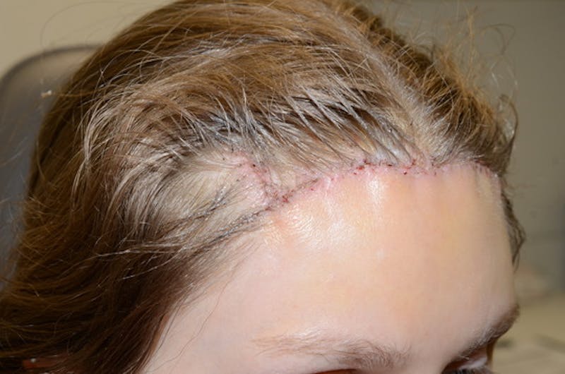 Hair Transplant Repair Before & After Gallery - Patient 538469 - Image 8