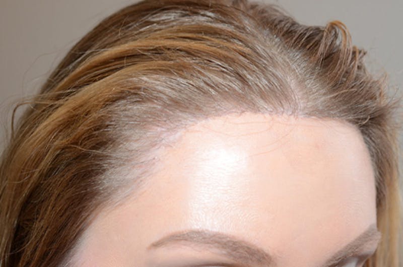 Hairline Lowering Surgery Before & After Gallery - Patient 306857 - Image 6