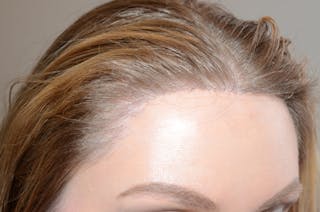 Hairline Lowering Surgery Before & After Gallery - Patient 306857 - Image 6