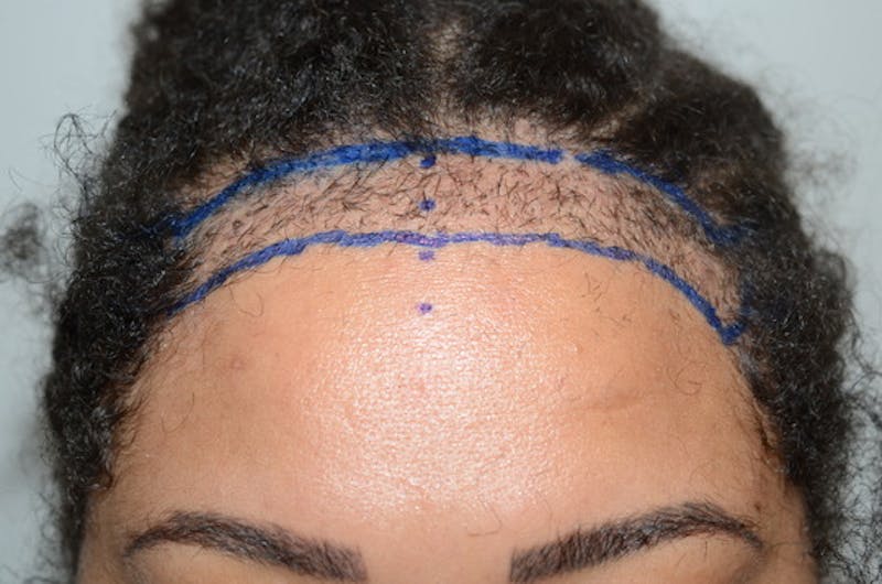 Hair Procedures for Women Before & After Gallery - Patient 332708 - Image 1