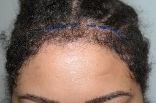 Hairline Lowering Surgery Before & After Gallery - Patient 640583 - Image 2
