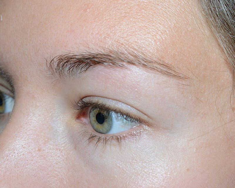 Eyebrow Transplantation Before & After Gallery - Patient 224754 - Image 3