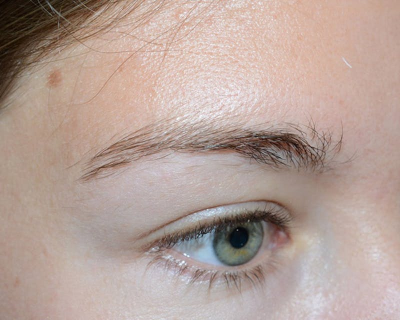 Eyebrow Transplantation Before & After Gallery - Patient 224754 - Image 5