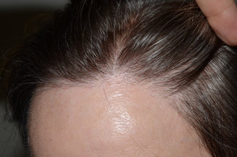 Hair Procedures for Women Before & After Gallery - Patient 322709 - Image 2
