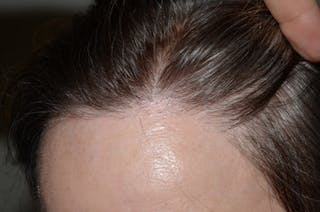 Hair Procedures for Women Before & After Gallery - Patient 322709 - Image 2