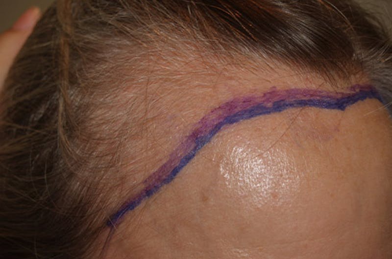 Hair Procedures for Women Before & After Gallery - Patient 322709 - Image 3