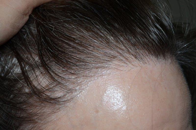 Hair Procedures for Women Before & After Gallery - Patient 322709 - Image 4