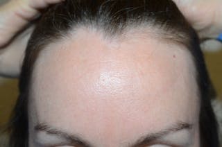 Hair Procedures for Women Before & After Gallery - Patient 316797 - Image 2