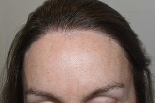 Hair Procedures for Women Before & After Gallery - Patient 298738 - Image 2