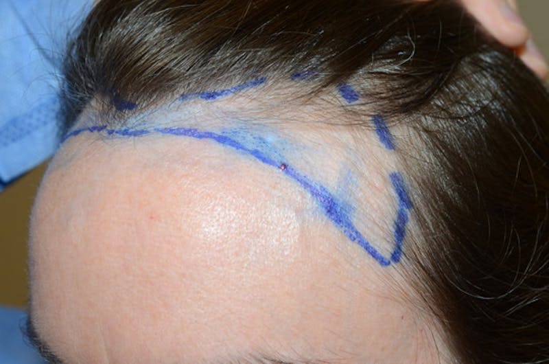 Hair Procedures for Women Before & After Gallery - Patient 298738 - Image 3
