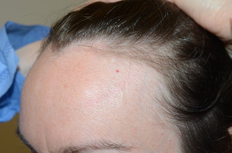 Hair Procedures for Women Before & After Gallery - Patient 316797 - Image 5