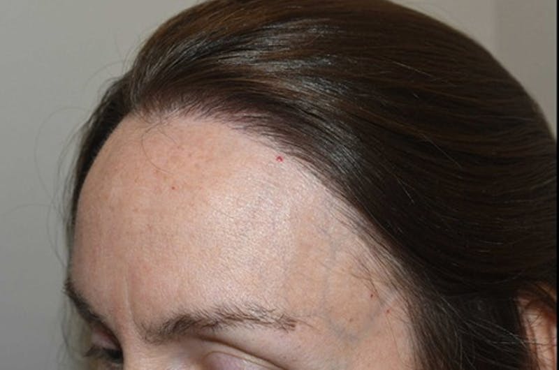 Hair Procedures for Women Before & After Gallery - Patient 298738 - Image 4