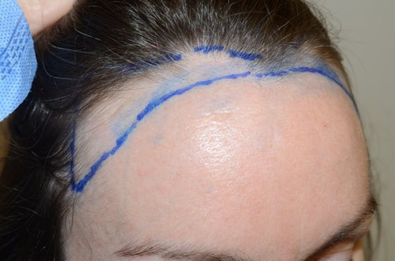 Hair Procedures for Women Before & After Gallery - Patient 298738 - Image 5
