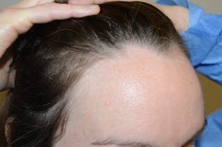 Hair Procedures for Women Before & After Gallery - Patient 316797 - Image 8