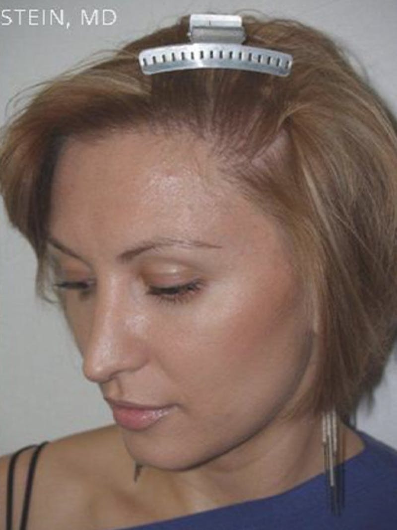 Hair Procedures for Women Before & After Gallery - Patient 228455 - Image 4