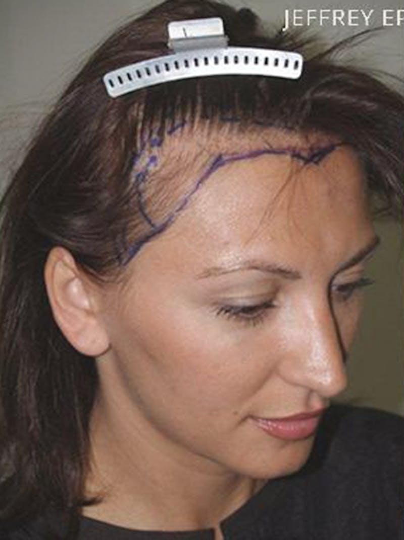Hair Procedures for Women Before & After Gallery - Patient 228455 - Image 5