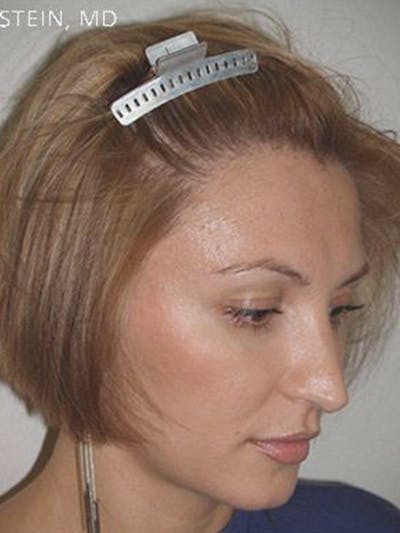 Hair Procedures for Women Before & After Gallery - Patient 156818 - Image 2