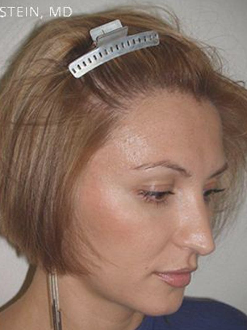 Hair Procedures for Women Before & After Gallery - Patient 228455 - Image 6