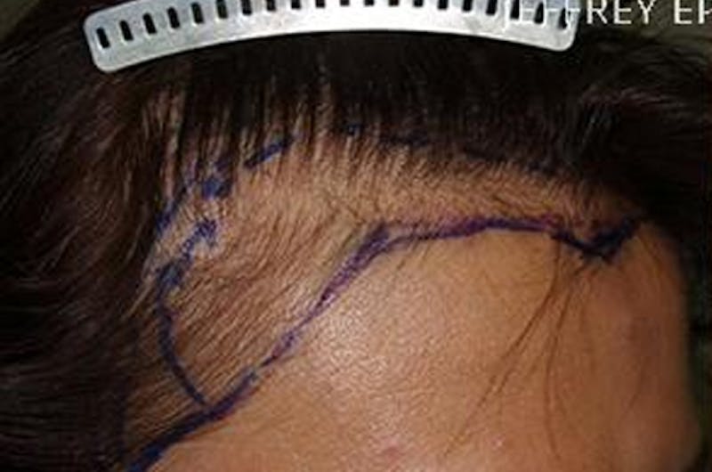 Hair Procedures for Women Before & After Gallery - Patient 228455 - Image 7