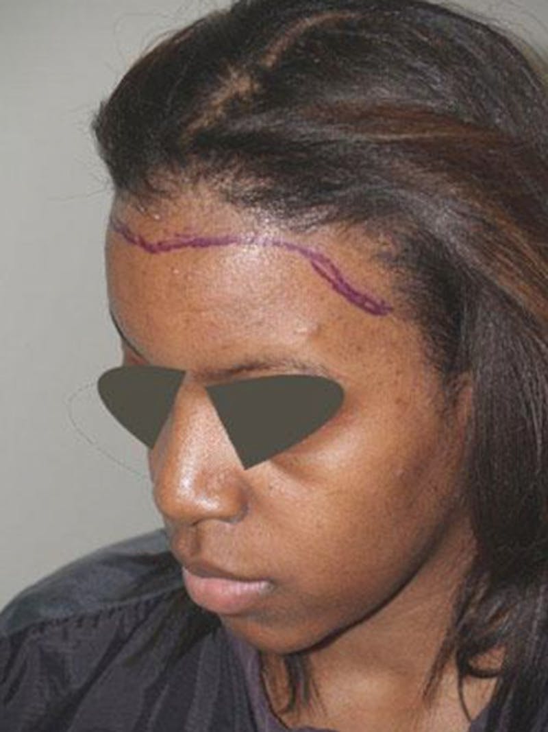 Hair Procedures for Women Before & After Gallery - Patient 242963 - Image 3