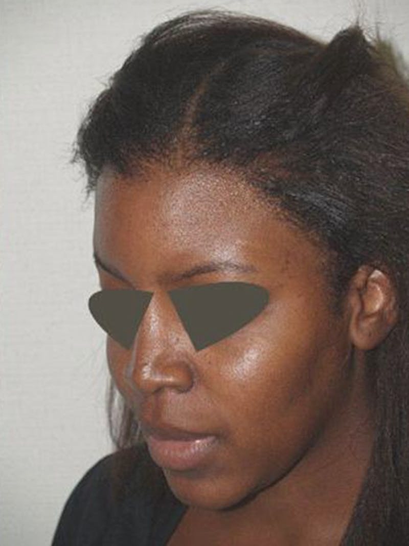 Hair Procedures for Women Before & After Gallery - Patient 242963 - Image 4