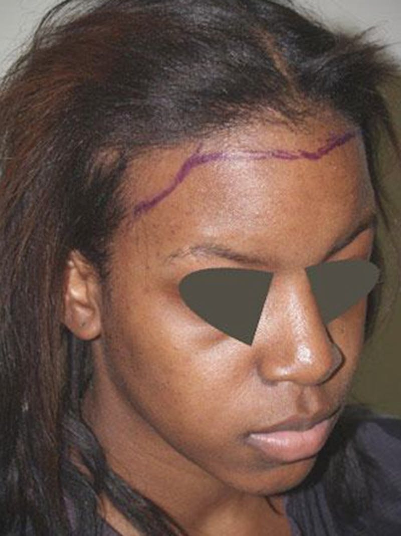 Hair Procedures for Women Before & After Gallery - Patient 242963 - Image 5