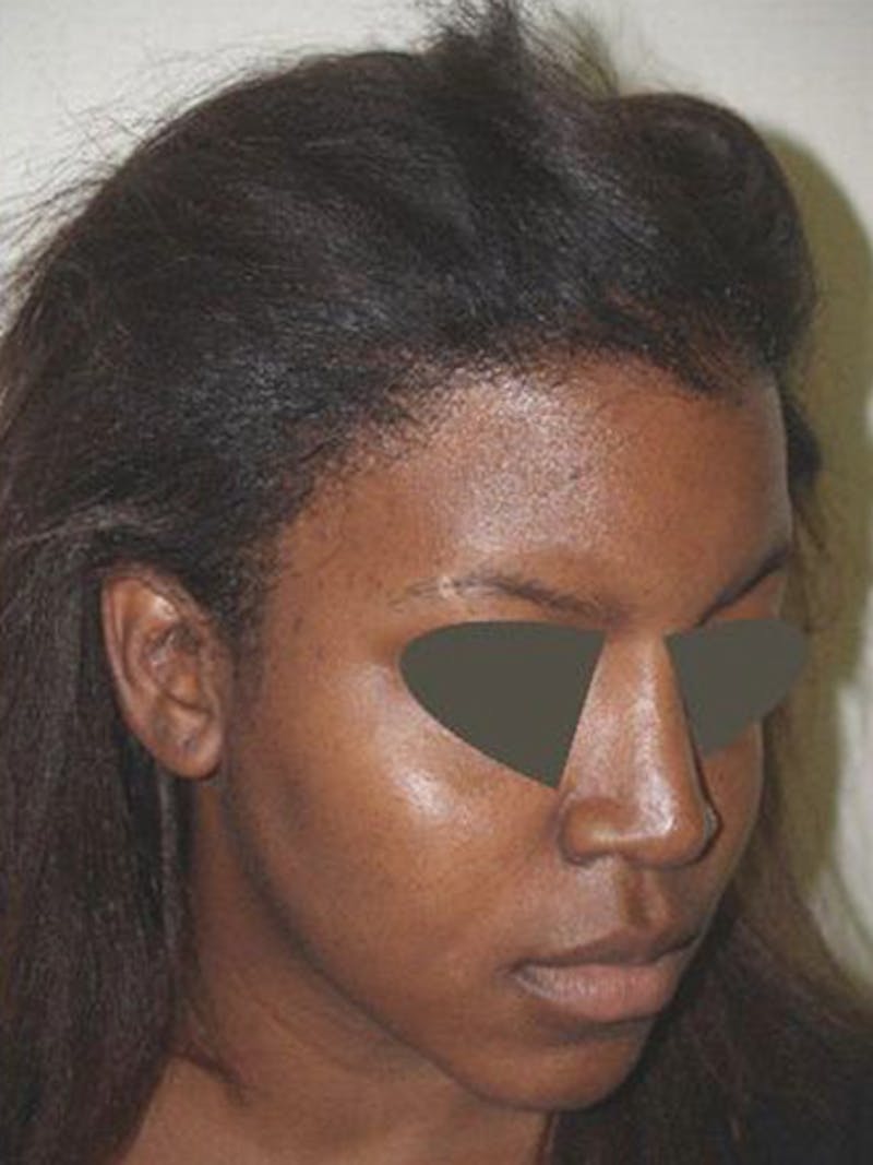 Hair Procedures for Women Before & After Gallery - Patient 242963 - Image 6