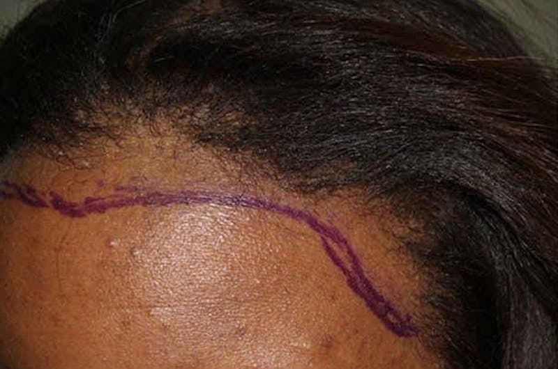 Hair Procedures for Women Before & After Gallery - Patient 242963 - Image 7