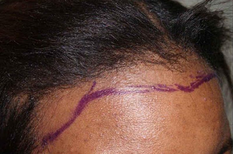 Hair Procedures for Women Before & After Gallery - Patient 242963 - Image 9