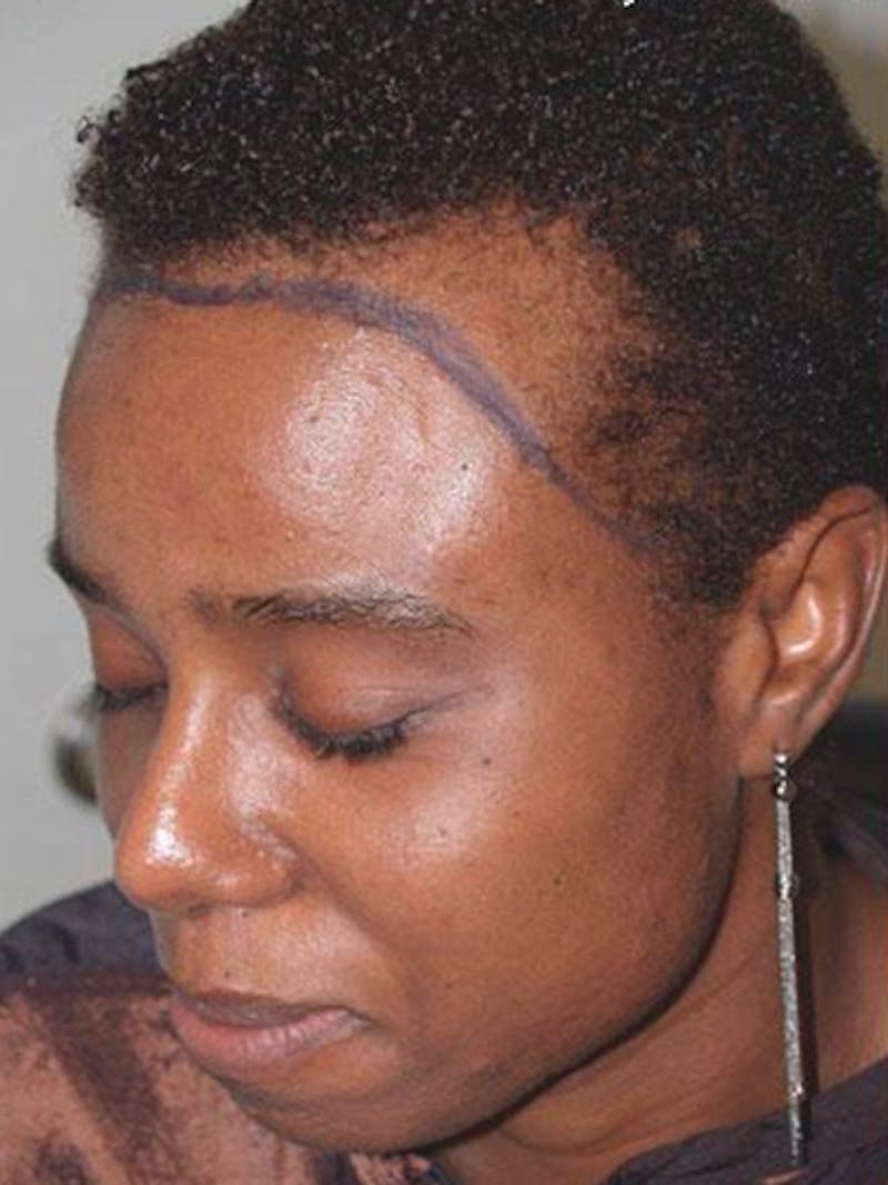 Hair Procedures for Women Before & After Gallery - Patient 369952 - Image 3