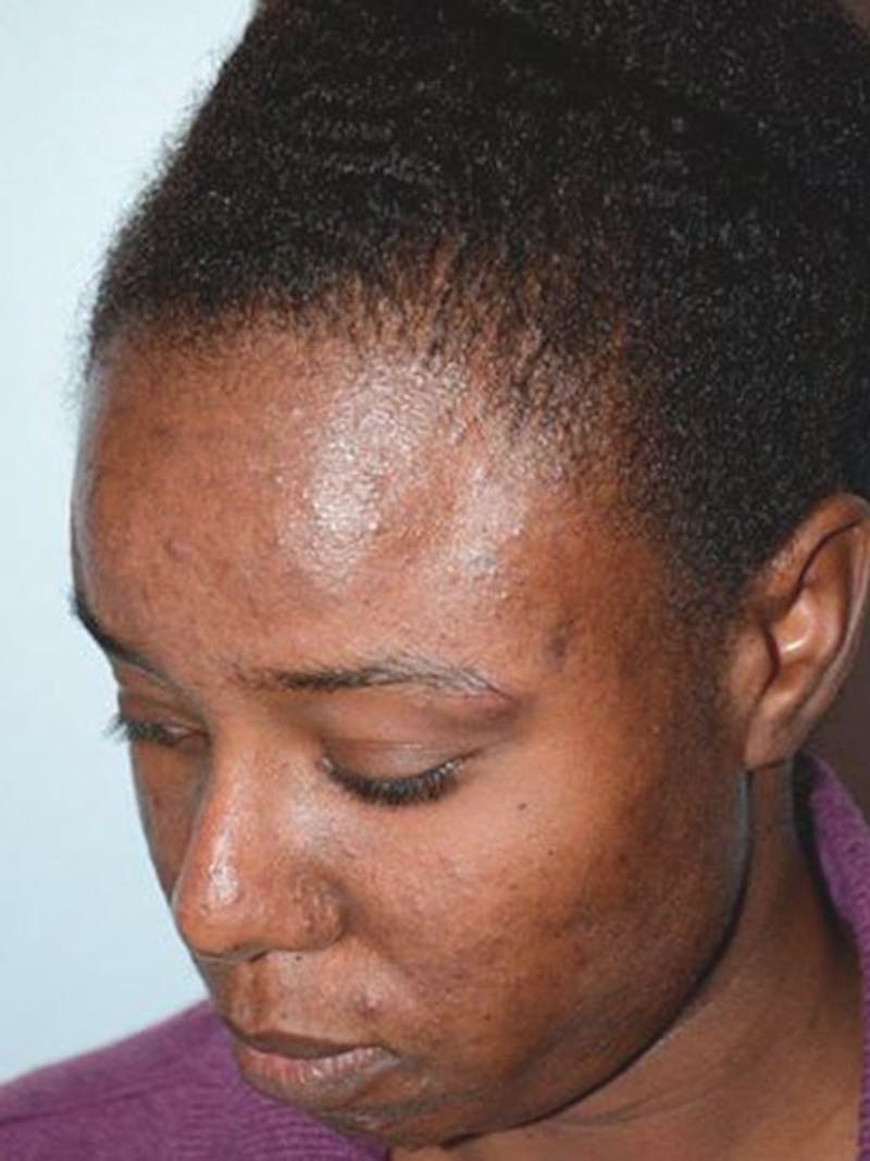 Hair Procedures for Women Before & After Gallery - Patient 369952 - Image 4