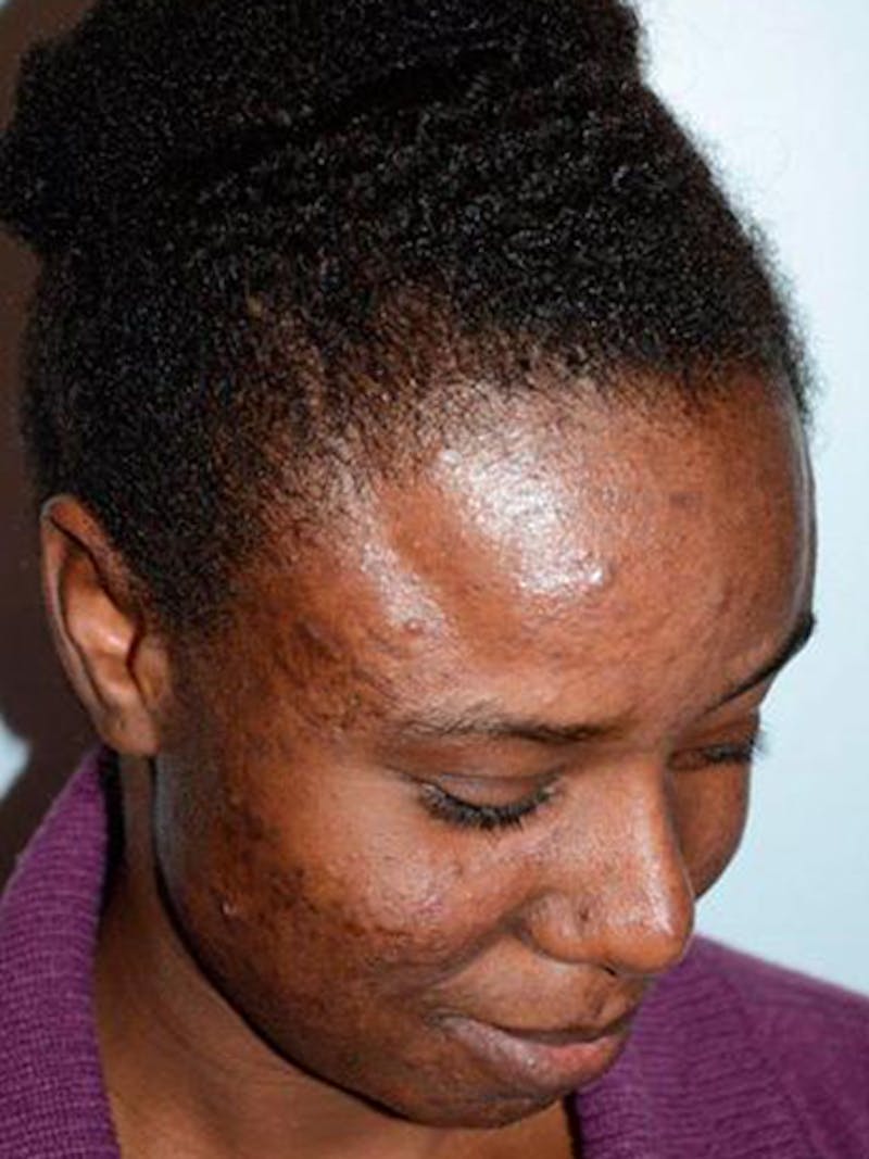 Hair Procedures for Women Before & After Gallery - Patient 369952 - Image 6